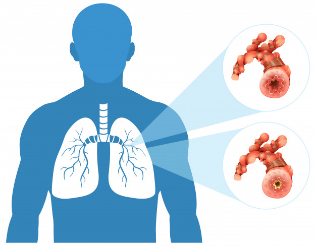 D'après une nouvelle étude parue dans l'European Respiratory Journal, le tissu adipeux qui s'accumule dans les parois respiratoires des personnes obèses pourrait expliquer leurs problèmes d'asthme.