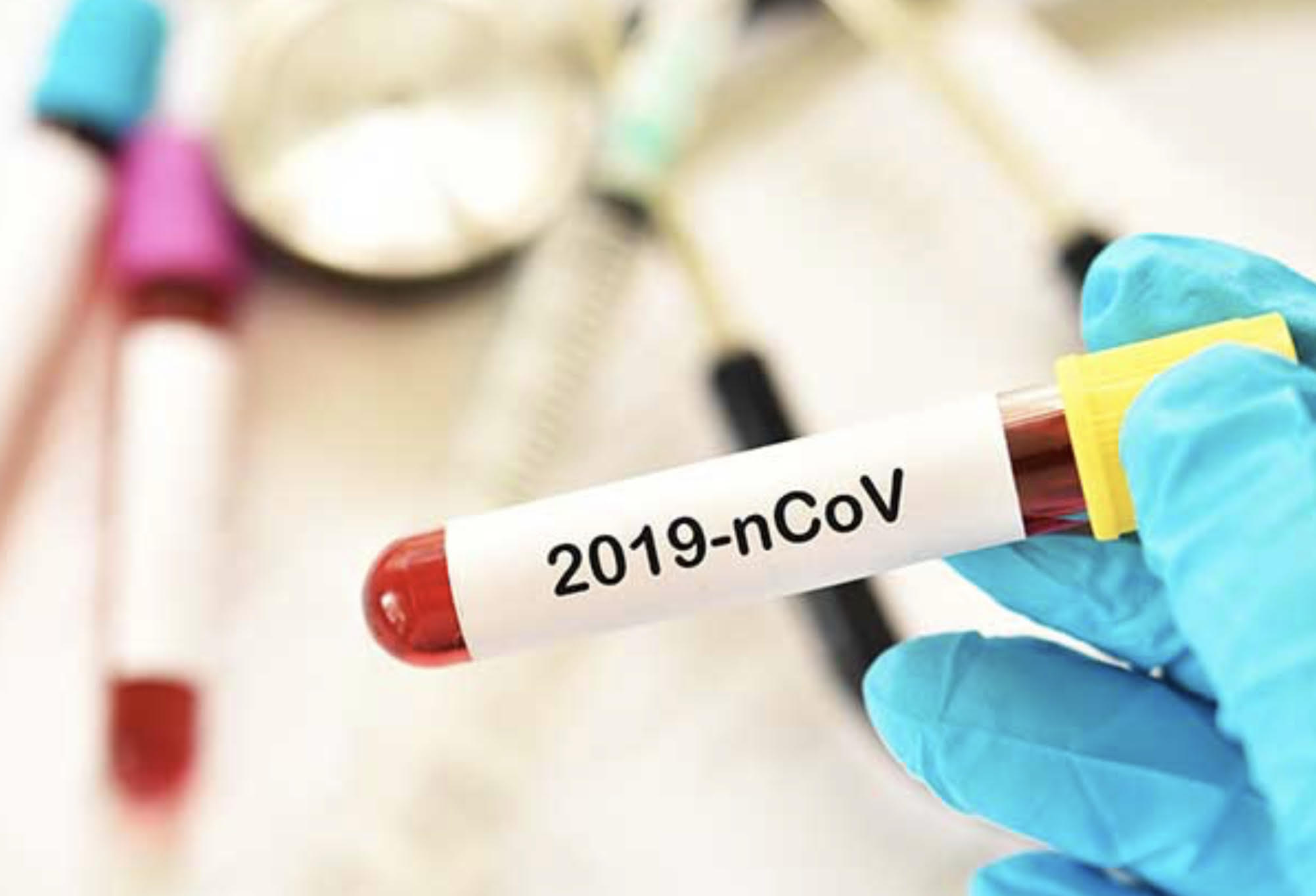 Des chiffres sont dévoilés et la tendance semble se confirmer : en France comme à l’étranger, de nombreux patients admis en réanimation après avoir été infectés au Covid-19 souffrent d'obésité. Jérôme Salomon, le directeur général de la santé, reconnaît que « l'obésité et, même le surpoids, peuvent devenir un facteur de risque d'infection sévère » au coronavirus. Des experts rappellent toutefois qu’il ne faut pas tirer de conclusions trop hâtives. Etat des lieux.