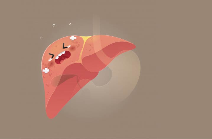 Une collaboration entre des chercheurs espagnols, français et allemands a permis d’identifier des biomarqueurs chez les patients souffrant d’obésité atteints par une inflammation du foie connue sous le nom de Nash. Ces caractéristiques biologique expliqueraient pourquoi ces personnes vulnérables ont un risque plus élevé en cas d’infection à la Covid-19.