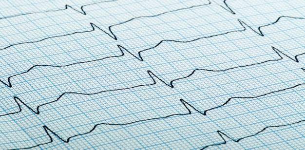 Des chercheurs suédois ont étudié le risque d’infarctus supplémentaires du myocarde et de décès précoce chez les patients gravement obèses qui subissent une chirurgie métabolique à la suite d’un événement myocardique. Les résultats sont encourageants.
